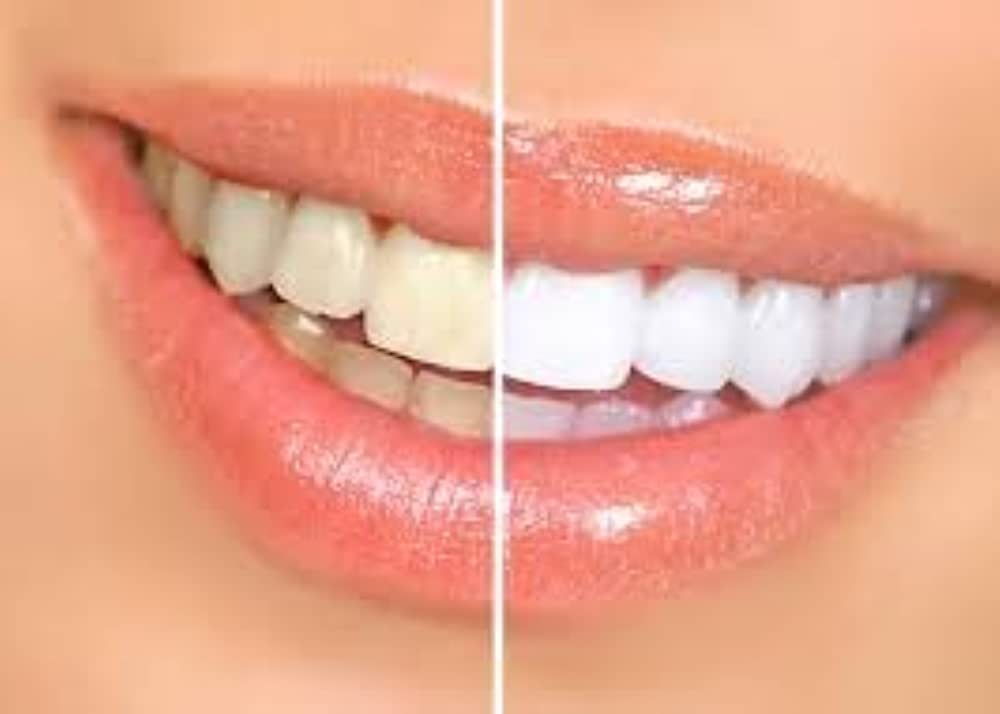 Ultimate White Whitening Dental Strips 6 Strips